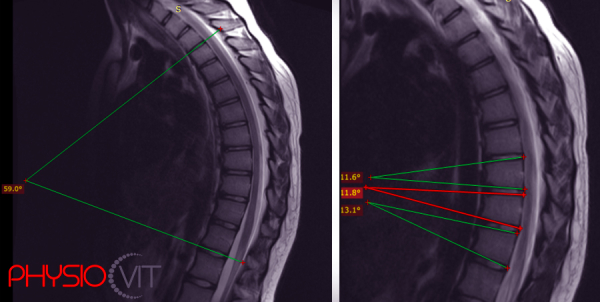 Scheuermann-betegség: Miért ne hagyja figyelmen kívül a gyermekek gerincének egészségét?