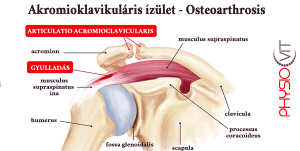 Az akromioklavikuláris ízületi kopás (AC OA) gyakori probléma, amely fájdalmat és mozgáskorlátozottságot okozhat a vállban. Ismerje meg, hogyan csökkentheti a fájdalmat fizioterápiás kezelésekkel, és milyen alternatív vagy műtéti megoldások érhetők el.